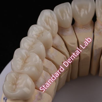 주문 디지털 CAD CAM 치과 연구실 PFZ 왕관 투명층 지르코니아 왕관 온라인 제품