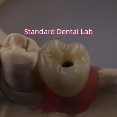 주문 스루브로 고정된 치아 임플란트 크라운 PFZ 포스텔렌 층 지르코니아 온라인 제품