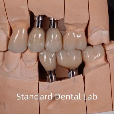 주문 자연스러운 외모 에스테틱 나사 유지 Zirconia 임플란트 왕관 온라인 제품