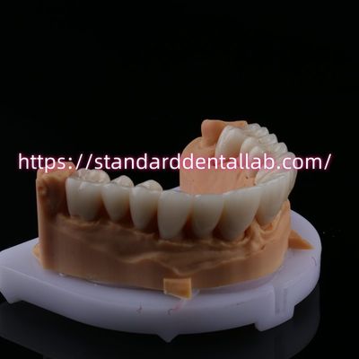 주문 FDA 높은 미용 치과 지르코니아 다리 층으로 된 포르셀린 지르코니아 치과 왕관 중국 치과 연구소 온라인 제품
