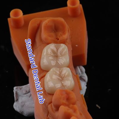 주문 전체 콘투르 지르코니아 왕관 투명성 3D PRO 포스텔리안 오버레이가 없습니다 표준 치과 연구실 온라인 제품