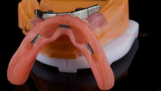 주문 이보클라 디지털 치아 임플란트 바 치아 장착장과 함께 완전 아크릴 치아 티타늄 임플란트 지원 치아 온라인 제품