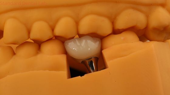 주문 3D 프린트 모델과 함께 스크루로 유지 치아 임플란트 왕관 치아 PFM 왕관 온라인 제품