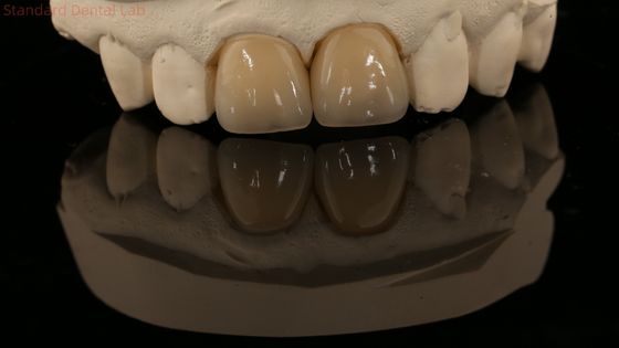 주문 전체 콘투르 지르코니아 왕관과 높은 미적 자연 치아 다리 5 년 보증 온라인 제품