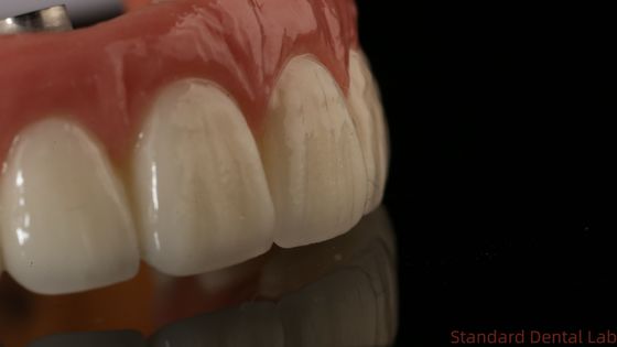 주문 전문 지르코니아 치아 임플란트 왕관 티타늄 CAD CAM 지르코니아 왕관 중국 치과 연구소 온라인 제품
