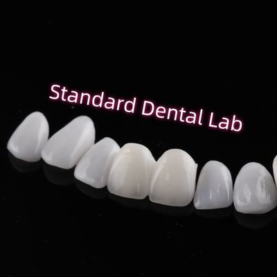 가려움증 저항성 Emax Zirconia 라미네이트 장단 절개 투명성