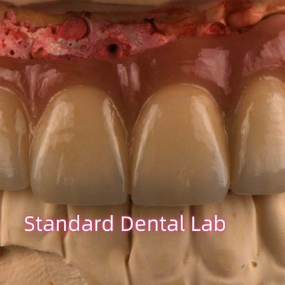 CAD CAM 프레싱 PFM 금속 고정 브리지에 합성 된 비 귀금류 포르셀라인