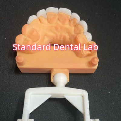 자연스러운 모양의 라미네이트 지르코니아 에맥스 플라니어 두께 0.6mm