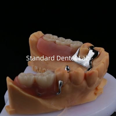 합금 금속 부분 치아 프레임 3 모양 Exocad 레이저 프린팅 하부 주름 부분 마무리