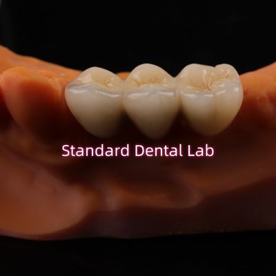 디지털 CAD CAM 치과 연구실 왕관 투명층 지르코니아 왕관