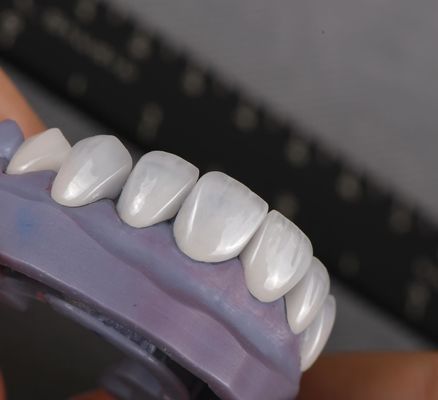자연스러운 모양의 Emax Veneers Crown Biocompatibility 최소 준비로 백색