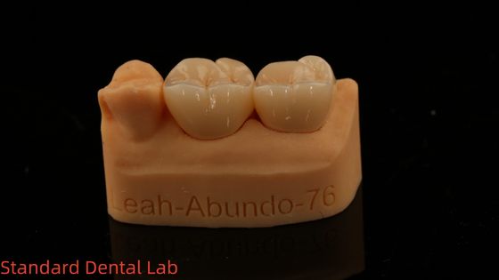 3D 프로 고 투명성 완전 지르코니아 왕관 5년 보증