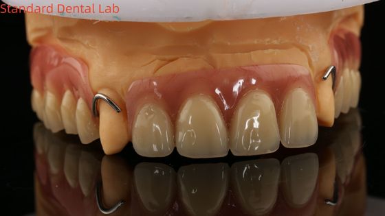열 절제 이보클라 부분 아크릴 치아 치아 연구실 3D 프린트 모델과 함께 높은 정확도