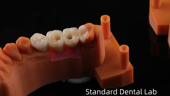 PFZ 포르셀라인 레이어드 지르코니아 5년 보증 및 3D 프린트 모델