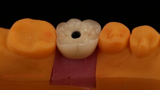 스크루 유지 된 PFZ 포르셀린 층 지르코니아 치아 임플란트 왕관 치아 연구소 ISO FDA CE 인증 5 년 보증