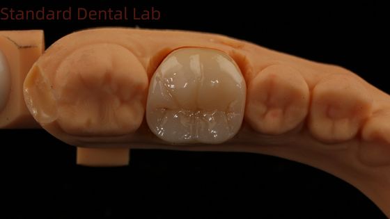 노리타케 포르셀라인 3D 프린트 모델과 함께 치과 디지털 전체 지르코니아 왕관 5년 보증