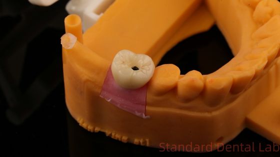 치아 임플란트 나사 3D 프린트 모델과 함께 PFZ 포르셀라인 레이어 지르코니아