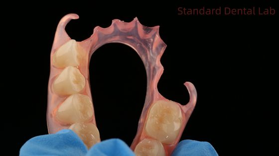 치과 TCS 밸플라스트 유연 부분 치과 치과 연구실 3D 프린트 모델 높은 미학