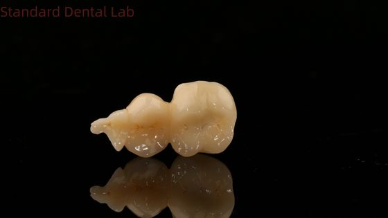 3D 프린트 모델 SDL 치과 연구실 지르코니아 온레이와 함께 치과 디지털 전체 지르코니아 왕관