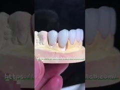 자연스러운 모양의 Emax Veneers Crown Biocompatibility 최소 준비로 백색