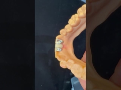 치과 치아 PFM 메릴랜드 브리지 높은 미용 FDA 인증