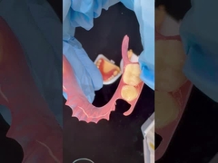 3D 프린트 모델 높은 미학 치과 TCS 밸플라스트 유연 부분 치과 치과 연구실